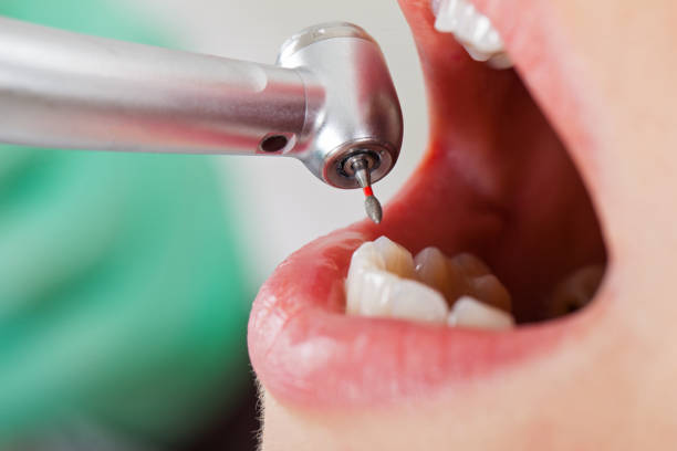 Best Knocked-Out Tooth (Avulsed Tooth) Treatment in Ennis, TX